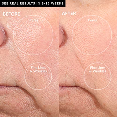 Personal Microderm Pro Microdermabrasion Machine with Exfoliating Crystals and Vacuum Suction B98708